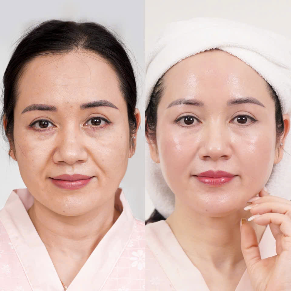 RF Three-Head Lifting and Wrinkle Removal Machine – Made In Korea